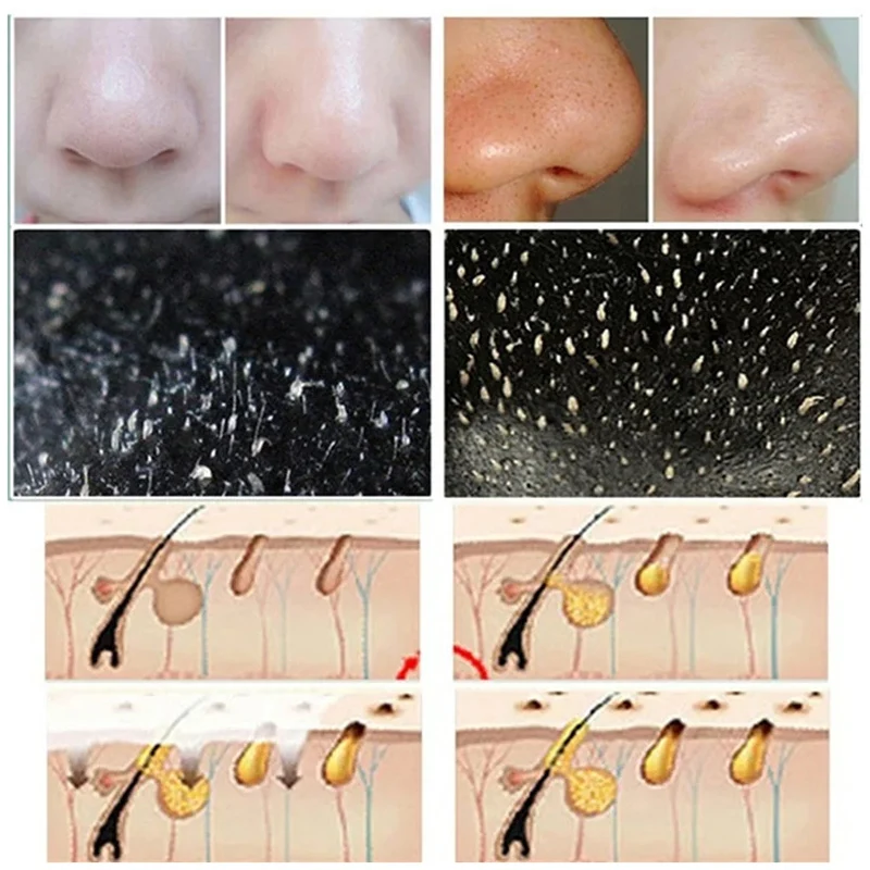 Tiras de espinillas para la na - Cleanser Face reseña y precio
